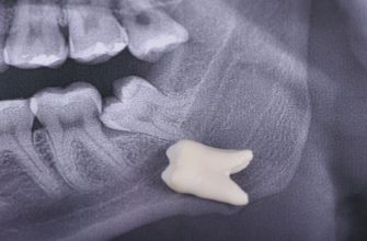 Видалення восьмих зубів: коли це необхідно та як підготуватися